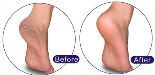 Cracked Heel - Treatment of Himalayan Pink Salt Stone