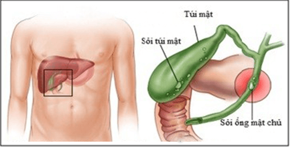 Các Triệu Chứng Tắc Nghẽn Mật Biểu Hiện Ở Đâu