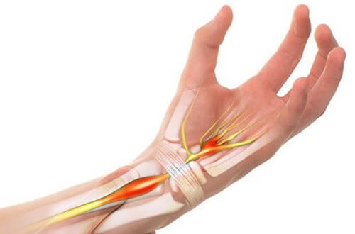 Viêm Bao Gân Là Gì? Cách Điều Trị Bệnh Như Thế Nào?
