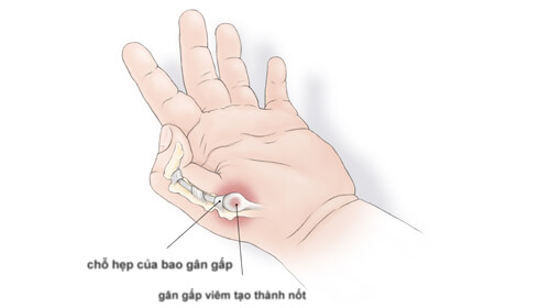 Đá Muối Hồng Có Trị Hết Bệnh Viêm Bao Gân Tay Chân Không? 1 2020