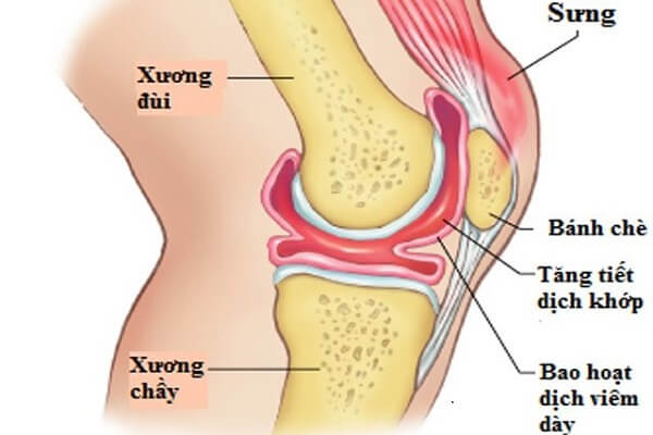 Photo of Giảm Đau Nhức Chứng Viêm Bao Hoạt Dịch