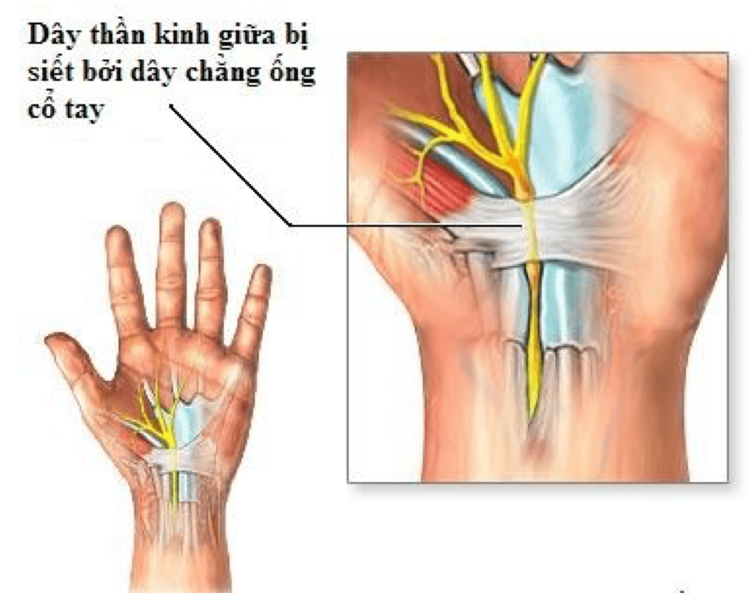 Photo of Hội Chứng Ống Cổ Tay Và Chuẩn Hỗ Trợ Điều Trị
