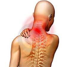 Vẹo đốt sống cổ: Trị ngay trước khi tạo ra hệ lụy 3 2020