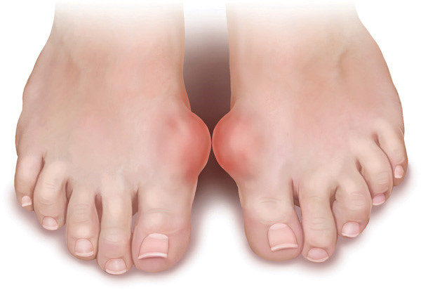 Bệnh Nhân Bị Bệnh Gút Nên Ăn Gì