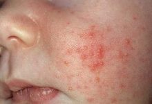 Photo of Bệnh Kê Ở Trẻ Nhỏ: 10 Vấn Đề Cần Lưu Ý Khi Điều Trị