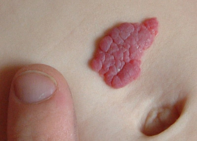 The 3 Most Common Treatments About Hemangioma in Children 1 2020