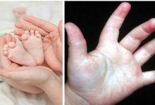 Photo of 4 Cách Điều Trị Bệnh Ra Mồi Hôi Tay Chân Cho Trẻ Em