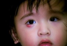 Photo of Top 3 Cách Chữa Lẹo Mắt Ở Trẻ Em Đơn Giản Và Hiệu Quả