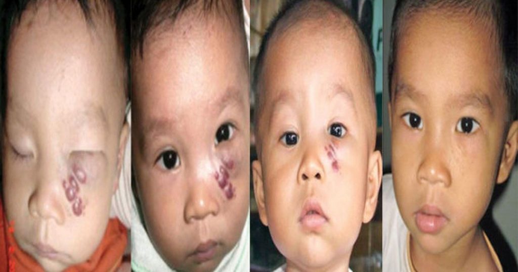 The 3 Most Common Treatments About Hemangioma in Children 2 2020