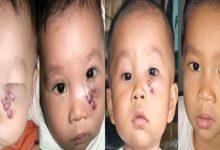 Photo of 3 Cách Điều Trị Phổ Biến Nhất Về Bệnh Bướu Máu Ở Trẻ Em