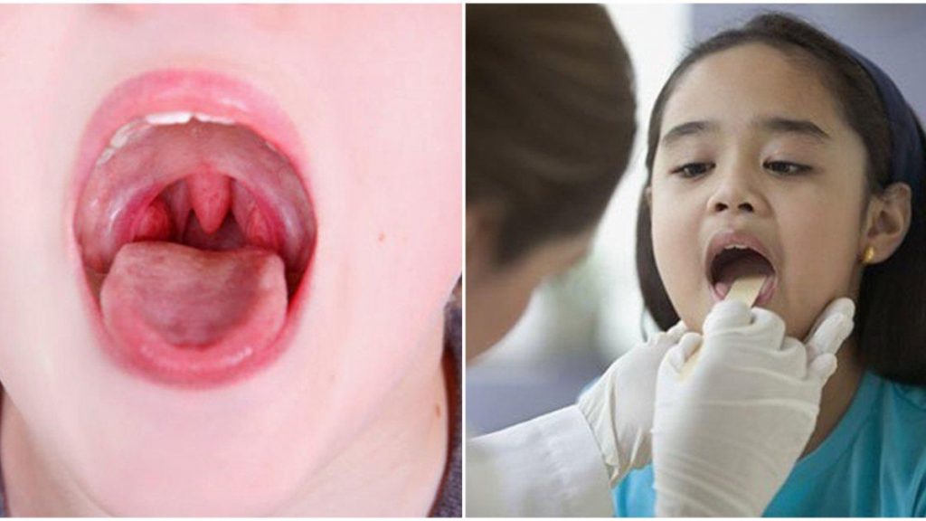 Cách chữa amidan hiệu quả nhất