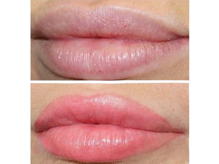 Phun Môi Collagen Kiêng Nước Trong Bao Lâu chuẩn nhất
