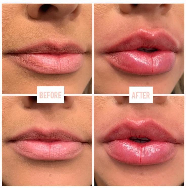 Các lời khuyên khi chọn Phun Môi Collagen