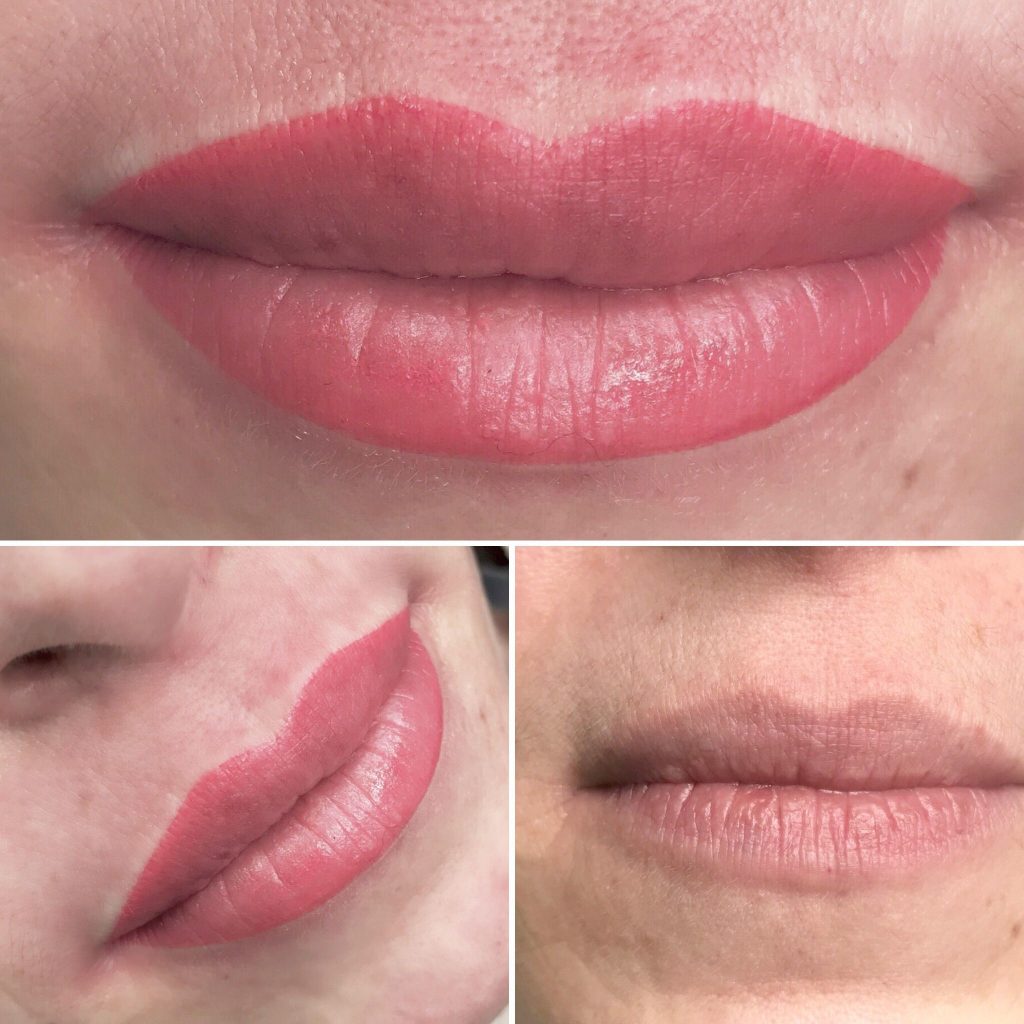 Đánh giá phương pháp Phun Môi Collagen