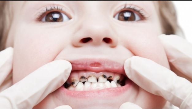 Prevention, Treatment: 05 Kinds of Dental Disease in Children 3 2020