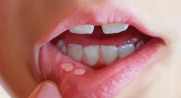 Prevention, Treatment: 05 Kinds of Dental Disease in Children 2 2020
