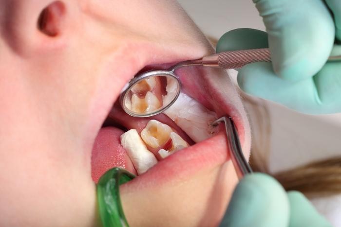 How to Prevent, Treat: 05 Types of Oral Disease in Children 4 2020